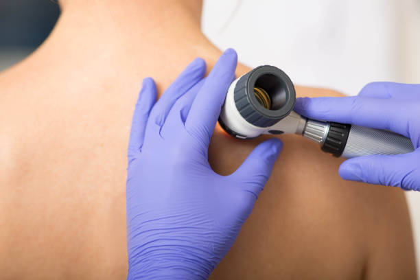 doctor examining patient skin moles with dermoscope